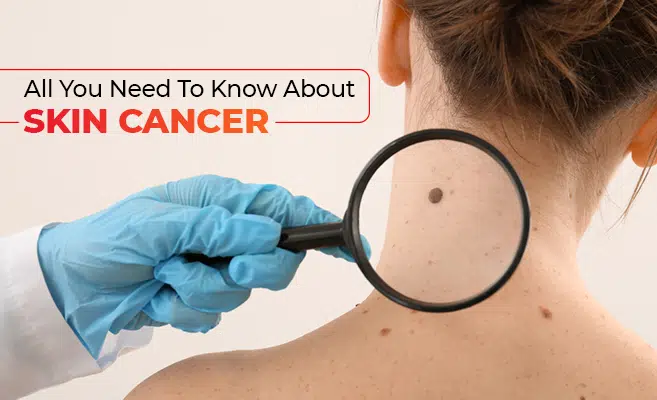 all-you-need-to-know-about-skin-cancer