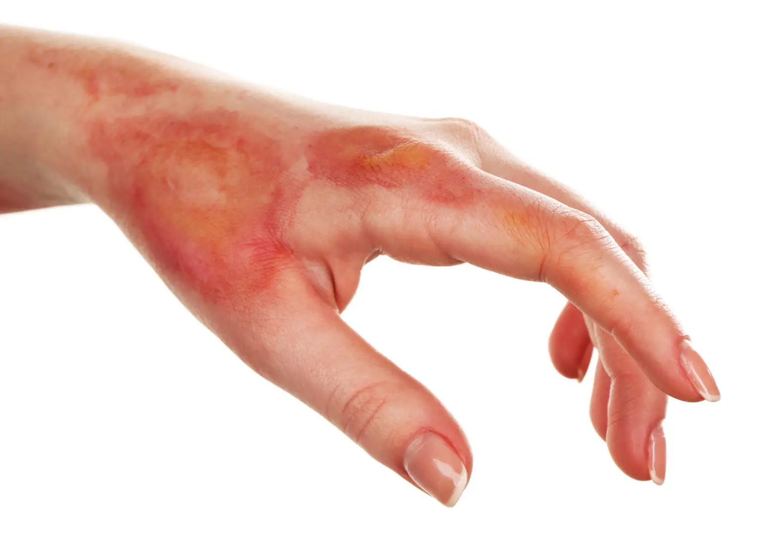 Burn Care Do’s and Don’ts : Treatment and Pain Management