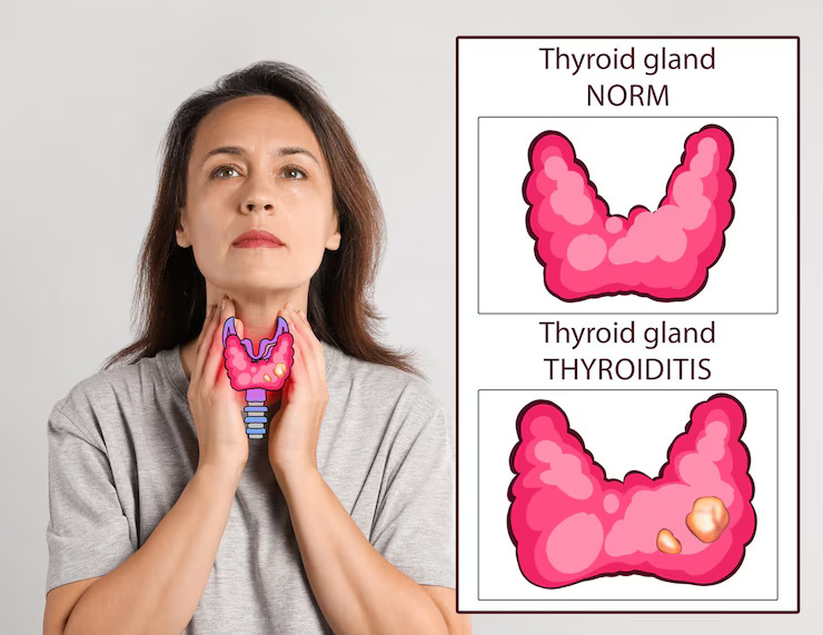 Thyroid