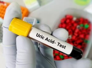 Ways to Lower Uric Acid Levels