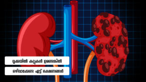 Kidney Stone Diet Plan and Prevention