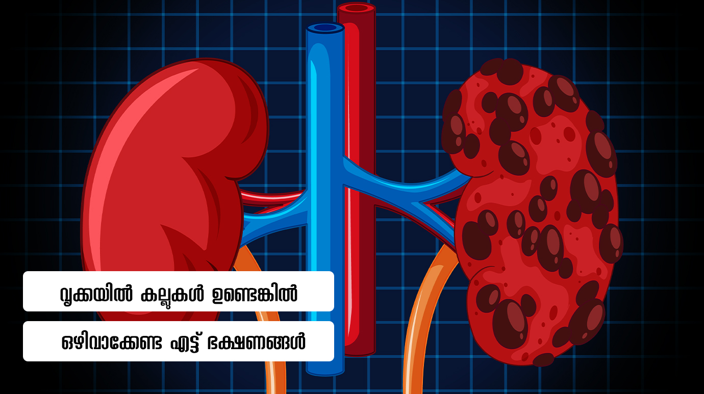 വൃക്കയിൽ കല്ലുകൾ ഉണ്ടെങ്കിൽ ഒഴിവാക്കേണ്ട 8 ഭക്ഷണങ്ങൾ(Kidney Stone Diet Plan and Prevention)