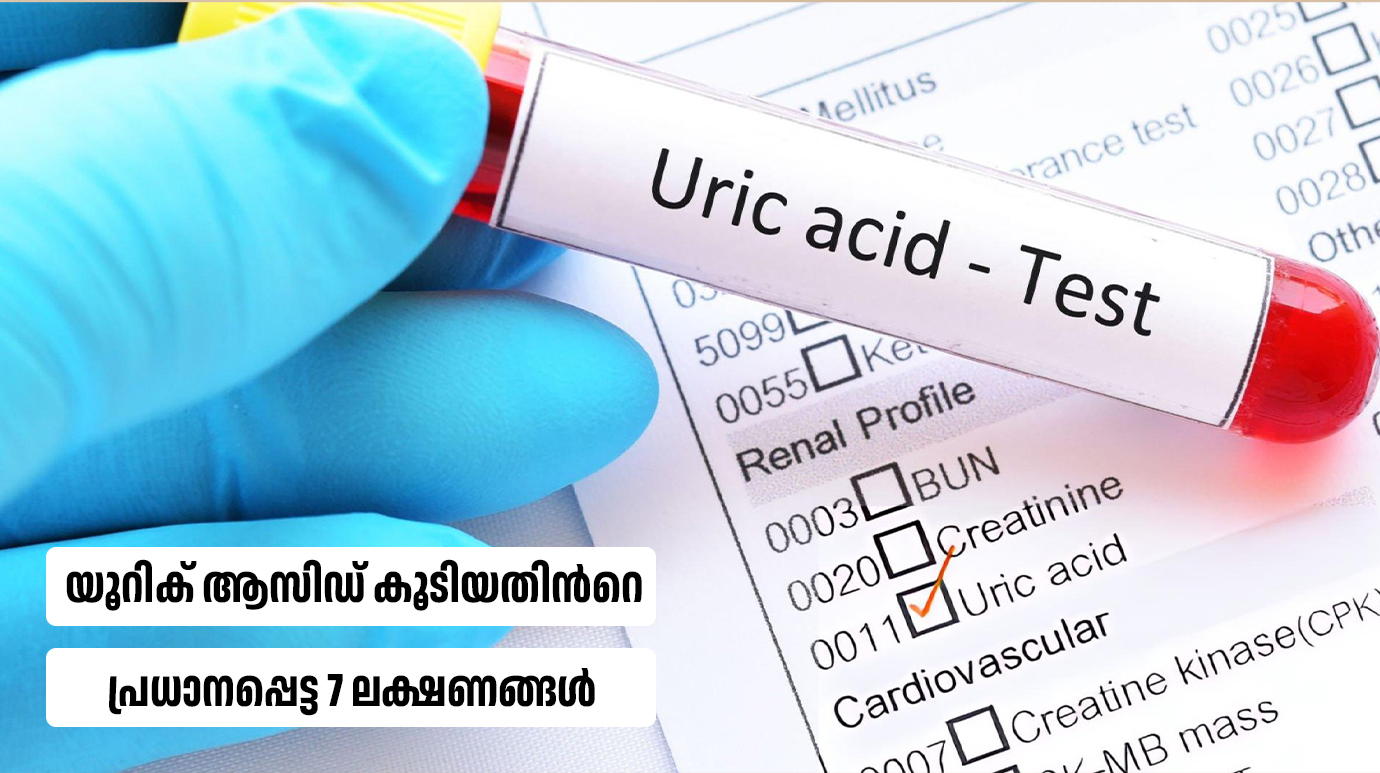 Important 7symptoms of high uric acid