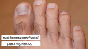 Toe hair loss diabetes sign