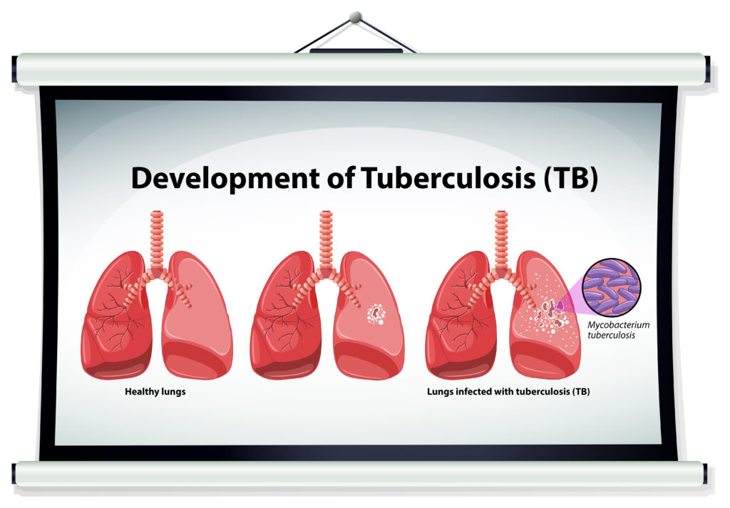 Can TB cause male infertility 