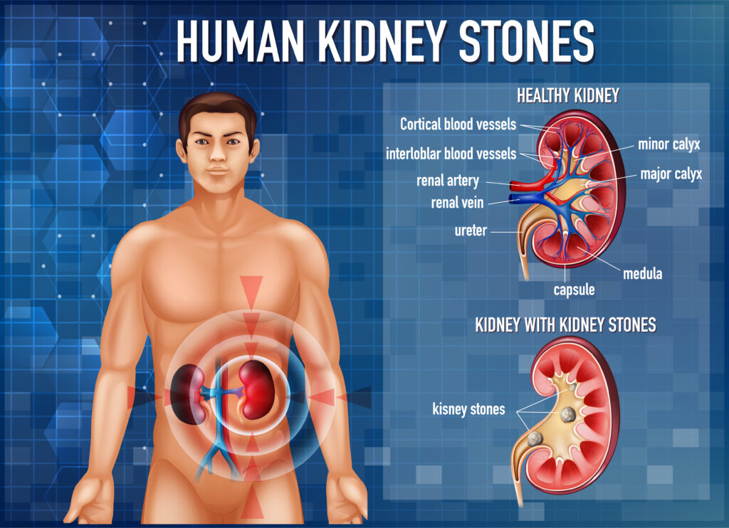 Kidney Disease Symptoms