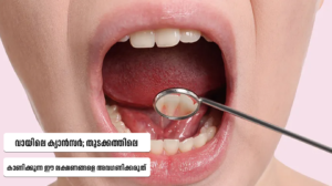 Early Symptoms of Mouth Cancer