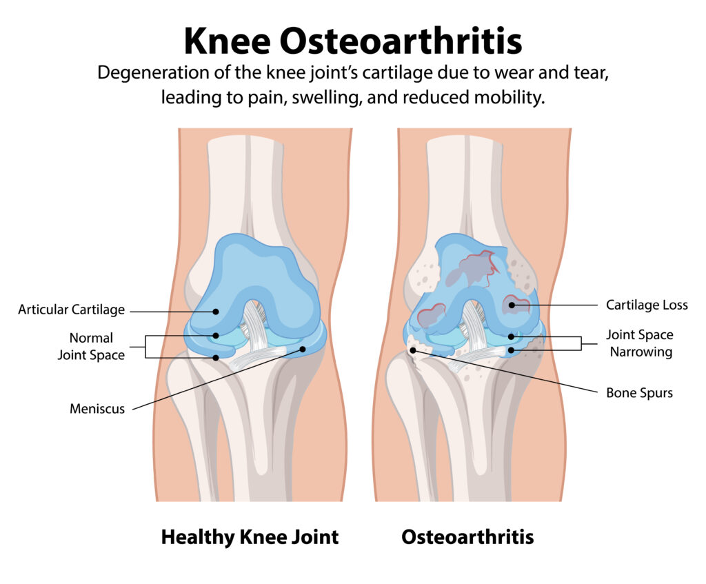 Causes of Morning Leg Pain