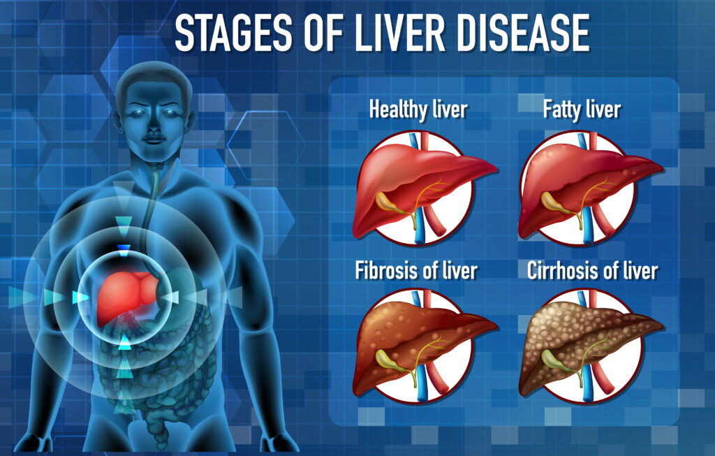 Coffee and Liver Cancer Risk