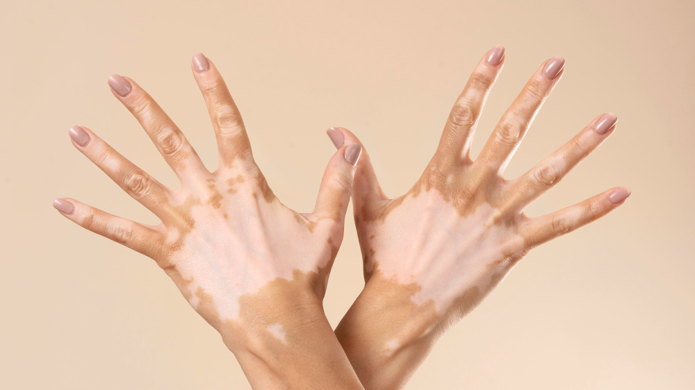 Early Signs of Vitiligo 