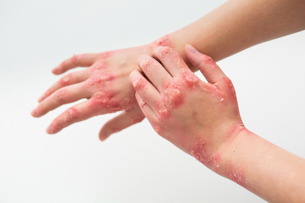 Early Signs of Vitiligo 