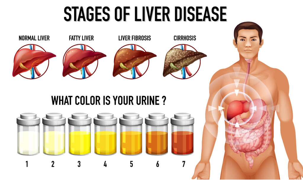 Silent Liver Disease Symptoms 