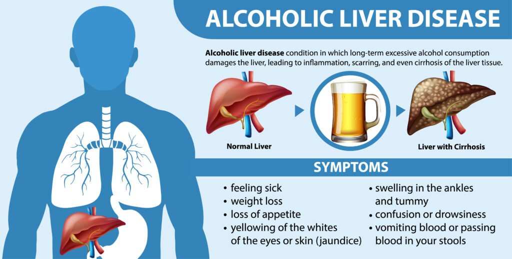 Silent Liver Disease Symptoms 