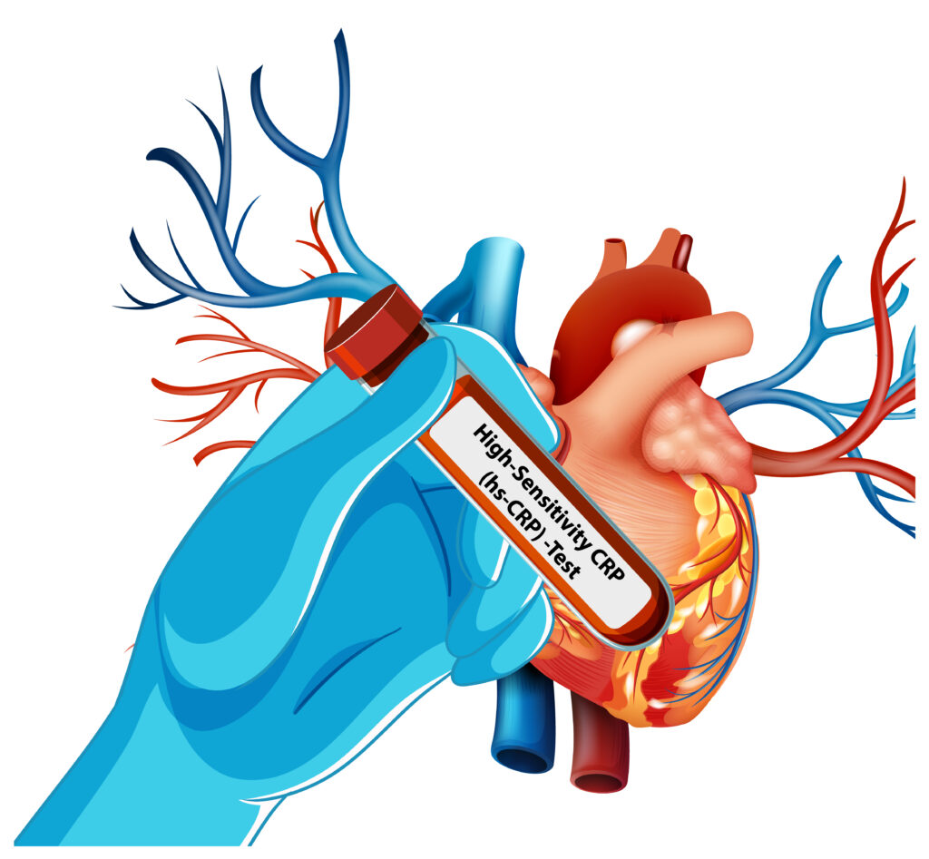 Atrial Fibrillation Symptoms 