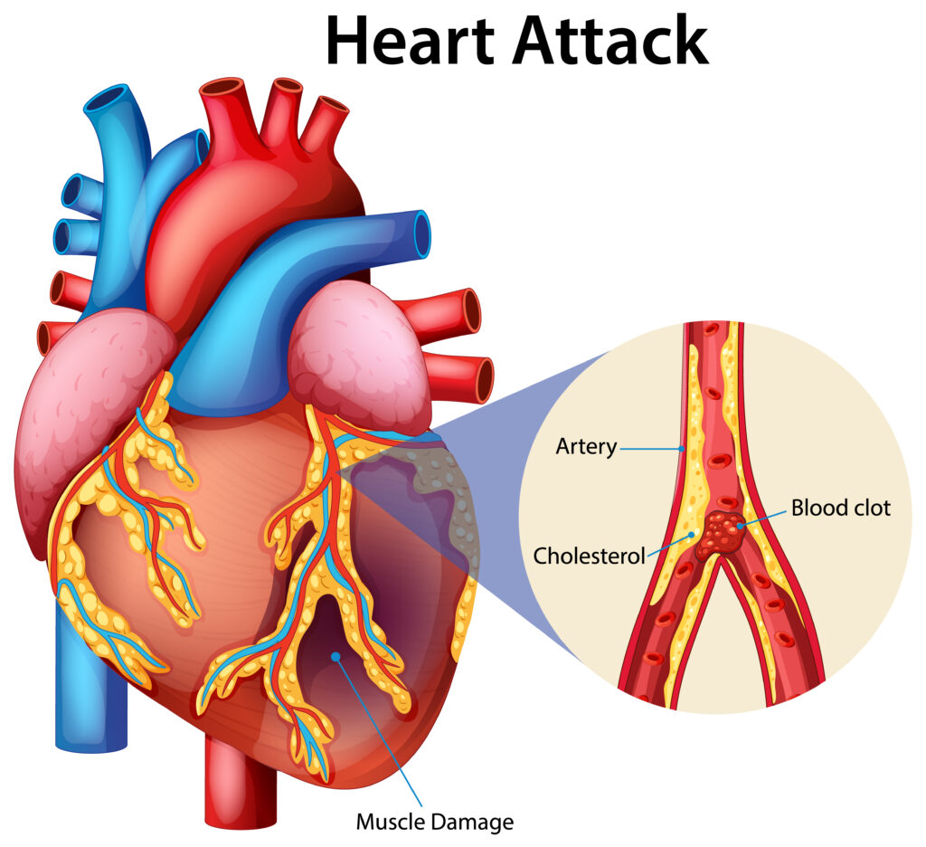 Short sleep & heart attack risk