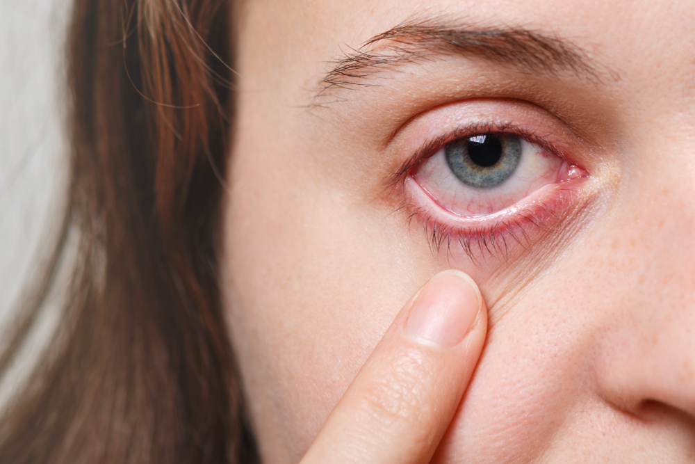 Serious Causes of Red Eyes